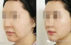 亿嘉琏私密小针,揭秘美容新潮流
